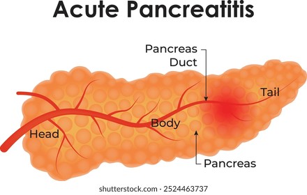 Pancreatitis aguda Cabeza Cuerpo Páncreas Páncreas Conducto Ilustración vectorial