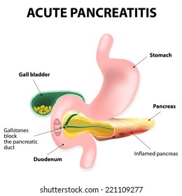 Acute pancreatitis is an inflammation of the pancreas. Gallstones block the flow of pancreatic juices into the duodenum. Digestive enzymes become active in pancreas, where they destroy healthy tissue.