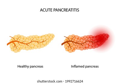 Logo de la pancreatitis aguda. El páncreas saludable e inflamado. Cesiones médicas y tratamiento. Dolor e inflamación en el aparato digestivo. Órganos internos humanos carteles anatómicos ilustraciones vectoriales planas