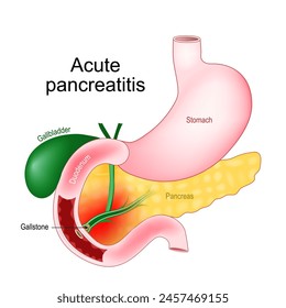 Acute pancreatitis. Pancreas inflammation. Realistic image of abdominal organs Gallbladder, Duodenum, Stomach, Pancreas. Close-up of a Gallstone that blocked of pancreatic duct and duodenal papilla