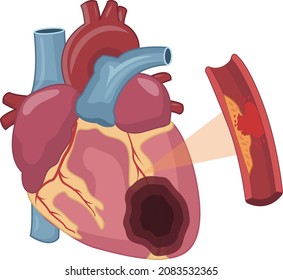 ruptura aguda de placa en infarto de miocardio ataque cardíaco