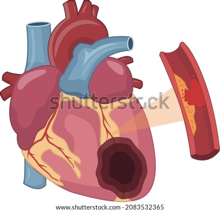 Acute plaque rupture in myocardial infarction heart attack Imagine de stoc © 