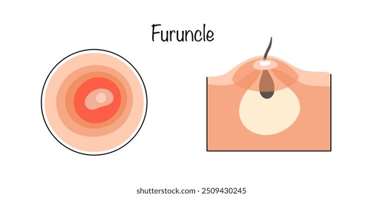 Acute purulent inflammation of the hair follicle, which spreads to the associated sebaceous gland and the subcutaneous fat tissue that surrounds them. Hand drawn boil. Vector illustration.