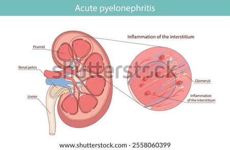 Acute pyelonephritis of the kidney. vector medical illustration