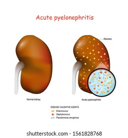 Acute pyelonephritis. Normal kidney and kidney with abscesses. Closeup of Bacteria that cause this disease. causative agents: Staphylococcus, Enterococcus, and Pseudomonas aeruginosa