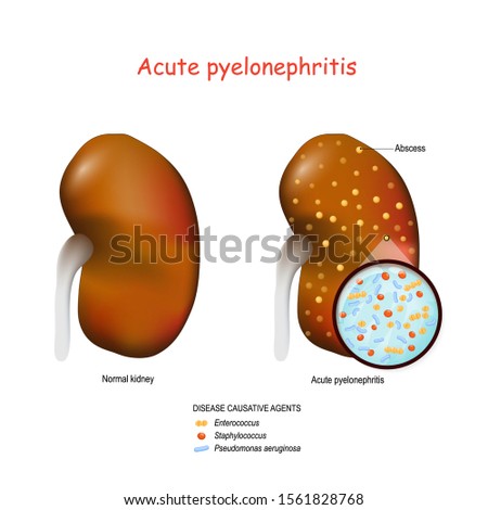 Acute pyelonephritis. Normal kidney and kidney with abscesses. Closeup of Bacteria that cause this disease. causative agents: Staphylococcus, Enterococcus, and Pseudomonas aeruginosa