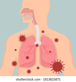 Síndrome de distrés respiratorio agudo (SDRA), insuficiencia respiratoria e inflamación en los pulmones