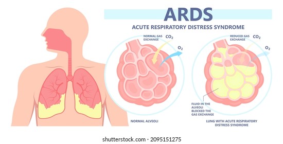 Acute respiratory distress syndrome (ARDS) a respiratory failure and inflammation in the lungs equipment hospital Emphysema fibrosis idiopathic Cystic Collapsed pneumothorax embolism X-Ray chest ICU