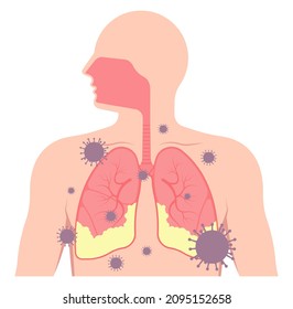 Acute respiratory distress syndrome (ARDS) a respiratory failure and inflammation in the lungs equipment hospital Emphysema fibrosis idiopathic Cystic Collapsed pneumothorax embolism X-Ray chest ICU