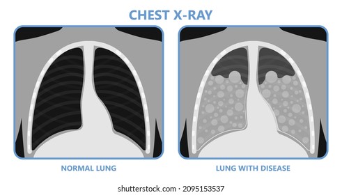 Radiografía del tórax utilizado para diagnosticar la enfermedad pulmonar