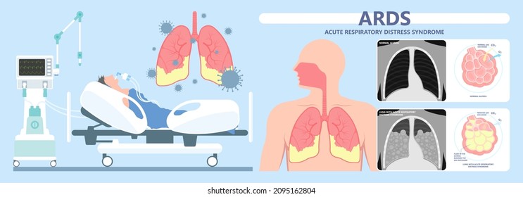 Acute respiratory distress syndrome (ARDS) a respiratory failure and inflammation in the lungs equipment hospital Emphysema fibrosis idiopathic Cystic Collapsed pneumothorax embolism X-Ray chest ICU