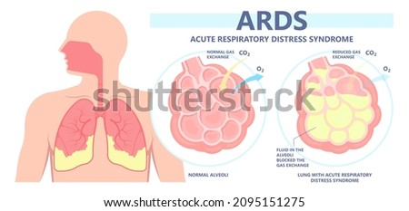 Acute respiratory distress syndrome (ARDS) a respiratory failure and inflammation in the lungs equipment hospital Emphysema fibrosis idiopathic Cystic Collapsed pneumothorax embolism X-Ray chest ICU Imagine de stoc © 