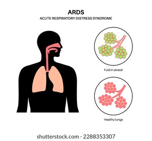 Acute respiratory distress syndrome. Lungs cannot enough oxygen. ARDS medical poster. Exudative, proliferative, and fibrotic stages. Unhealthy internal organs. Respiratory system vector illustration