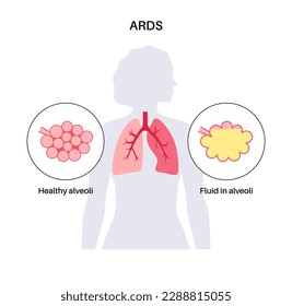 Acute respiratory distress syndrome. Lungs cannot enough oxygen. ARDS medical poster. Exudative, proliferative, and fibrotic stages. Unhealthy internal organs. Respiratory system vector illustration