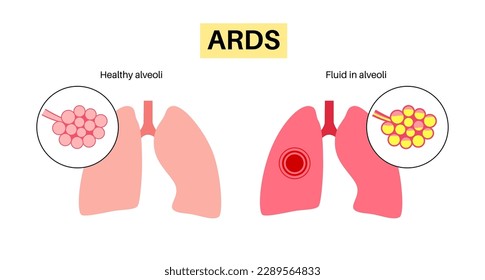Acute respiratory distress syndrome. Lungs cannot enough oxygen. ARDS medical poster. Exudative, proliferative, and fibrotic stages. Unhealthy internal organs. Respiratory system vector illustration