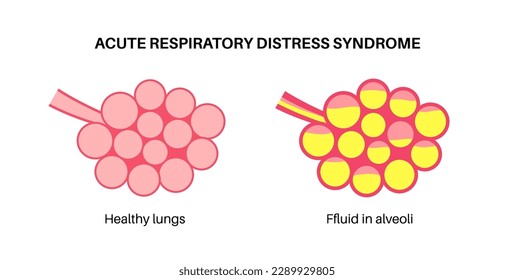 Acute respiratory distress syndrome. Lungs cannot enough oxygen. ARDS medical poster. Exudative, proliferative, and fibrotic stages. Unhealthy internal organs. Respiratory system vector illustration