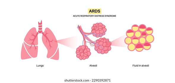 Acute respiratory distress syndrome. Lungs cannot enough oxygen. ARDS medical poster. Exudative, proliferative, and fibrotic stages. Unhealthy internal organs. Respiratory system vector illustration