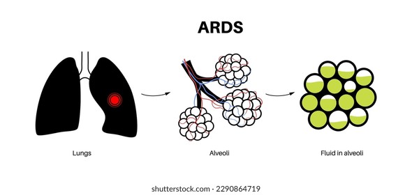 Acute respiratory distress syndrome. Lungs cannot enough oxygen. ARDS medical poster. Exudative, proliferative, and fibrotic stages. Unhealthy internal organs. Respiratory system vector illustration