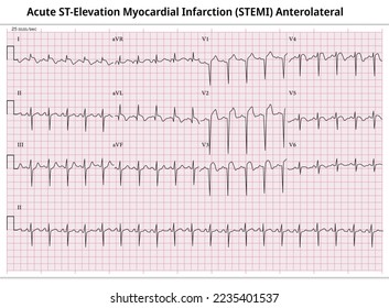 Akute ST-Elevation Myokardinfarkt (STEMI) Anterolaterale - ECG-Papier 12 Blei