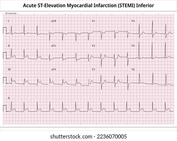 Acute ST-Elevation Myocardial Infarction (STEMI) Inferior - ECG Paper 12 Lead