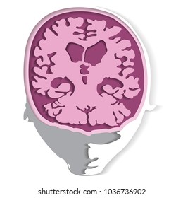 AD brain illustration 