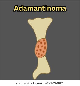 adamantinoma non cancerous bone tumor in long bone illustration useful for educational and healthcare industries orthopedics