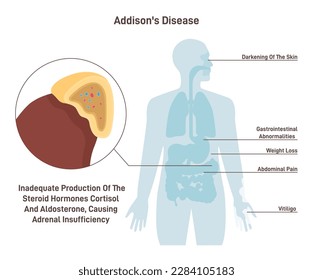 Enfermedad de Addison. Síntomas de insuficiencia renal crónica o hipocortisolismo e hipoadrenalismo. Silueta humana con órganos internos y glándulas suprarrenales. Ilustración vectorial plana