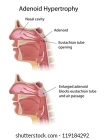 Adenoid Hypertrophy