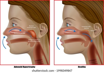 Adenoid Hypertrophy, The Abnormal Growth Of The Pharyngeal Tonsils. Adenoidectomy Or Adenoid Removal. Eustachian Tube Dysfunction