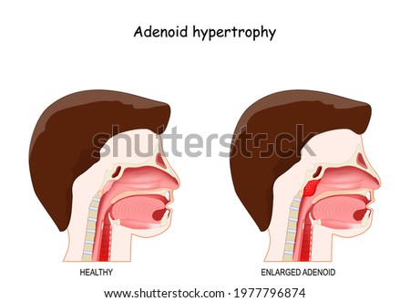 Adenoid hypertrophy. Cross section of the human's head with healthy and inflammation enlarged adenoids. vector illustration