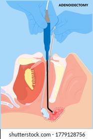 Adenoid Hypertrophy Ear ENT Cold Neck Nose Pain Sore Acute Apnea Gland Media Mouth Nasal Sinus Sleep Treat Viral Airway Common Facies Otitis