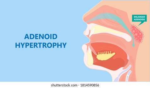 Adenoid Hypertrophy Ear ENT Cold Neck Nose Pain Sore Acute Apnea Gland Media Mouth Nasal Sinus Sleep Treat Viral Airway Common Facies Otitis