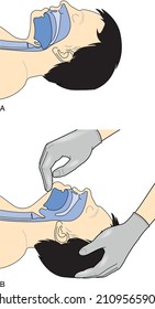 Adenoid Hypertrophy Ear ENT Cold Neck Nose Pain Sore Acute Apnea Gland Media Mouth Nasal Sinus Sleep Treat Viral Airway Common Facies Otitis