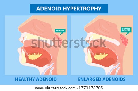 Adenoid hypertrophy ear ENT cold neck nose pain Sore acute apnea gland media mouth nasal sinus sleep treat viral airway common facies otitis