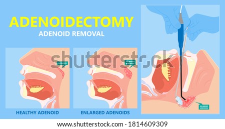 Adenoid hypertrophy ear ENT cold neck nose pain Sore acute apnea gland media mouth nasal sinus sleep treat viral airway common facies otitis