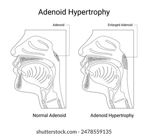 Adenoid hypertrophy medical design with line style illustration