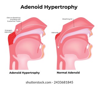 Adenoid Hypertrophy Science Design Vector Illustration Diagram