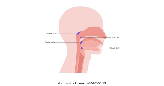 Adenoid medical poster, pharyngeal tonsil, a mass of lymphoid tissue located in the upper part of the throat behind the nose. Immune system concept. Children health medical flat vector illustration.