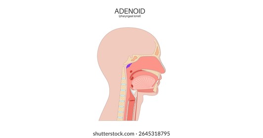 Cartaz médico adenoide, tonsila faríngea, uma massa de tecido linfoide localizado na parte superior da garganta atrás do nariz. Conceito de sistema imunitário. Ilustração de vetor plano médico de saúde infantil.