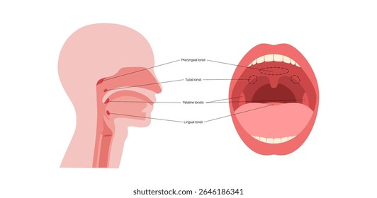 Cartaz médico adenoide, tonsila faríngea, uma massa de tecido linfoide localizado na parte superior da garganta atrás do nariz. Conceito de sistema imunitário. Ilustração de vetor plano médico de saúde infantil.