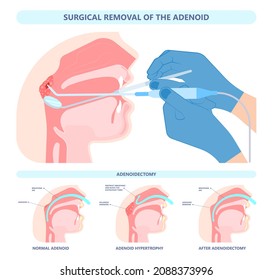 Adenoidectomy. Throat back voice box larynx vocal cord pain airway endoscopic sinus surgery ear nose sleep apnea oral airway septal obstructive biopsy tumor Pharynx flexible fibre optic polypectomy
