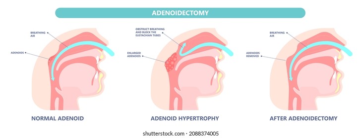 Adenoidectomy. Throat Back Voice Box Larynx Vocal Cord Pain Airway Endoscopic Sinus Surgery Ear Nose Sleep Apnea Oral Airway Septal Obstructive Biopsy Tumor Pharynx Flexible Fibre Optic Polypectomy