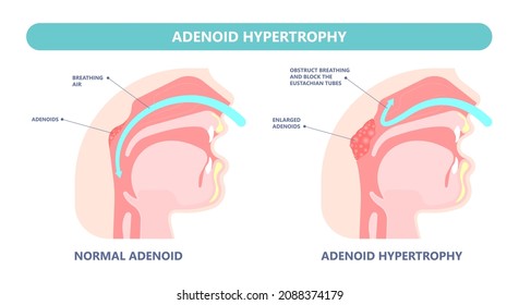 Adenoidectomy. Throat back voice box larynx vocal cord pain airway endoscopic sinus surgery ear nose sleep apnea oral airway septal obstructive biopsy tumor Pharynx flexible fibre optic polypectomy