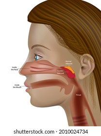 Adenoids, Pharyngeal Tonsil Or Nasopharyngeal Tonsil (Human Anatomy). Otolaryngology Adenoid Hypertrophy
