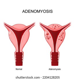 Adenomyosis. Comparación de útero normal e insalubre para mujeres anormales. sistema reproductivo femenino. condición médica cuando las células endometrio se encuentran atípicamente entre las células de las células del uterino