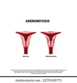 Adenomyosis. Comparison normal and unhealthy abnormal women uterus. female reproductive system. medical condition when cells endometrium atypically located among the cells of the cells of the uterine