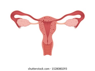 Adenomyosis. Sick female reproductive system isolated on white background. Сross section of an internal organ.