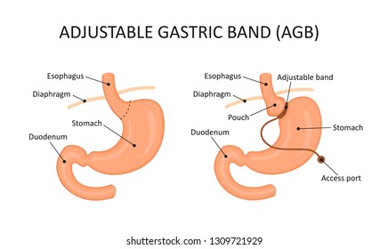 Adjustable Gastric Band (AGB)