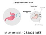 Adjustable Gastric Band. Medical gastroenterology infographic