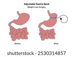 Adjustable Gastric Band. Medical gastroenterology infographic